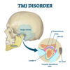 TMJ（顎関節症）